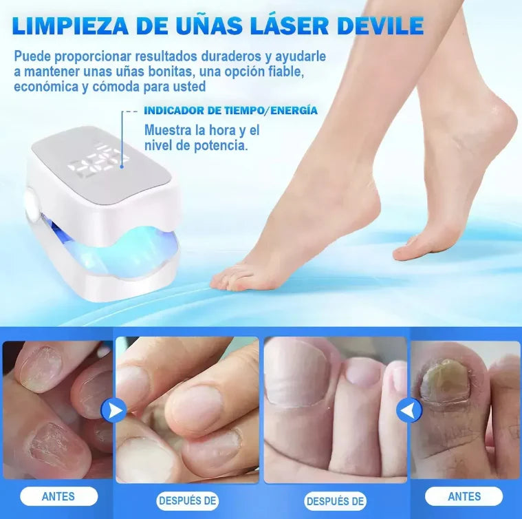 Dispositivo láser para hongos en las uñas Orthowl®